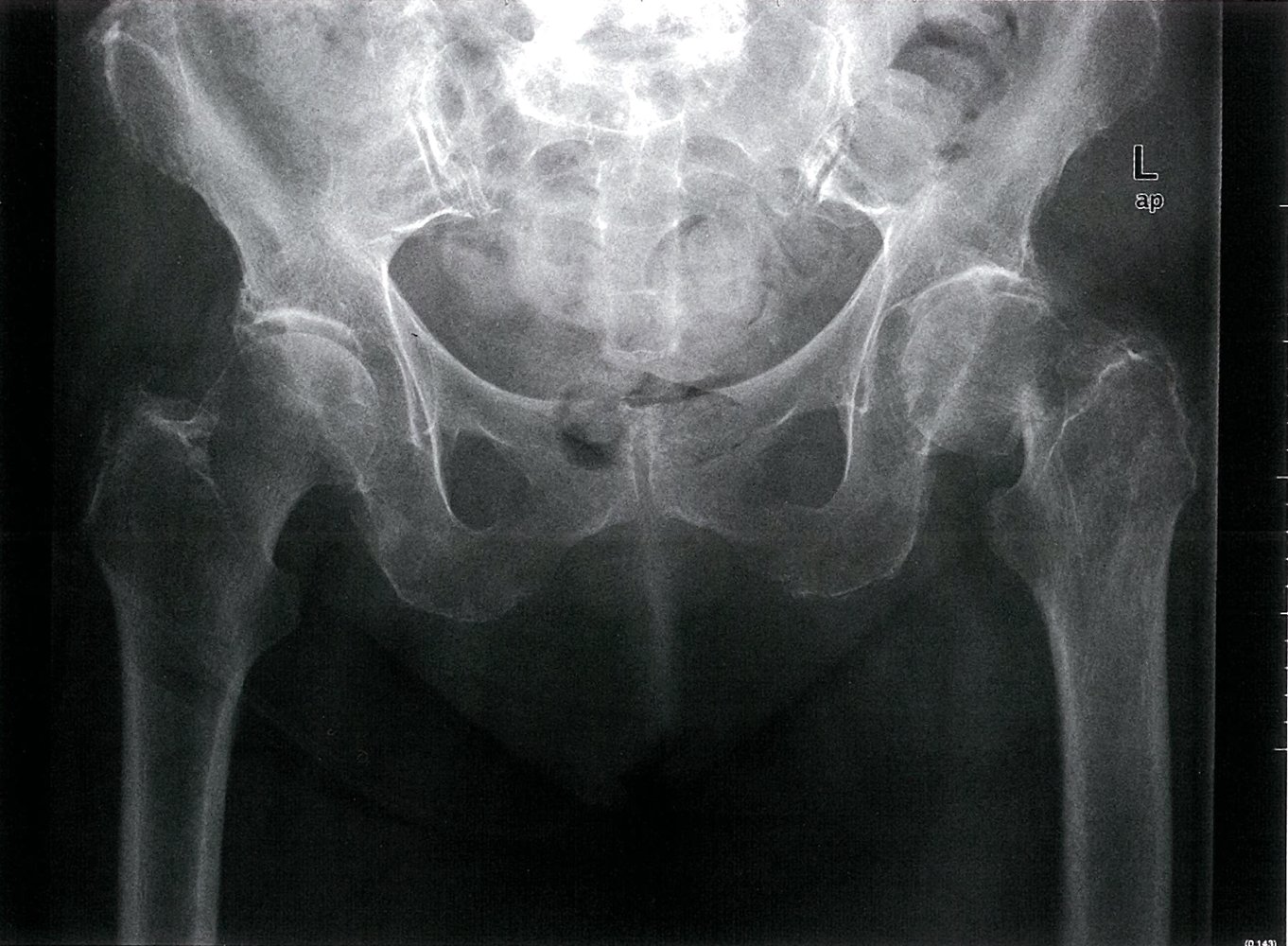 Femoral neck fracture