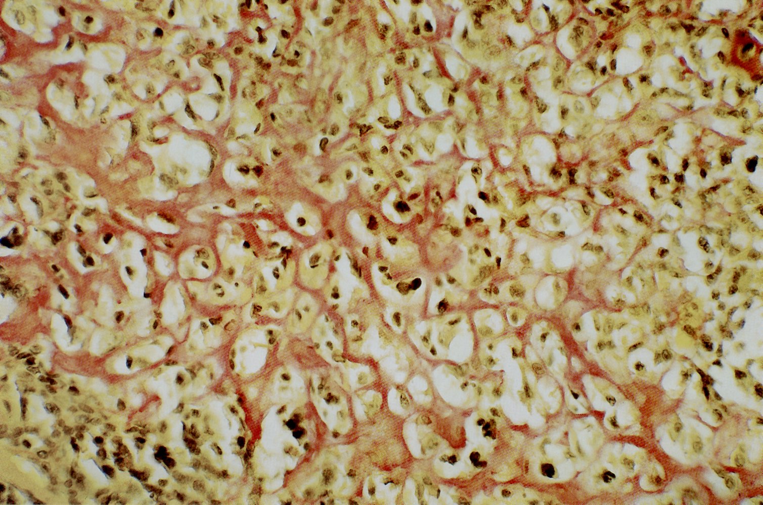 Osteosarcoma