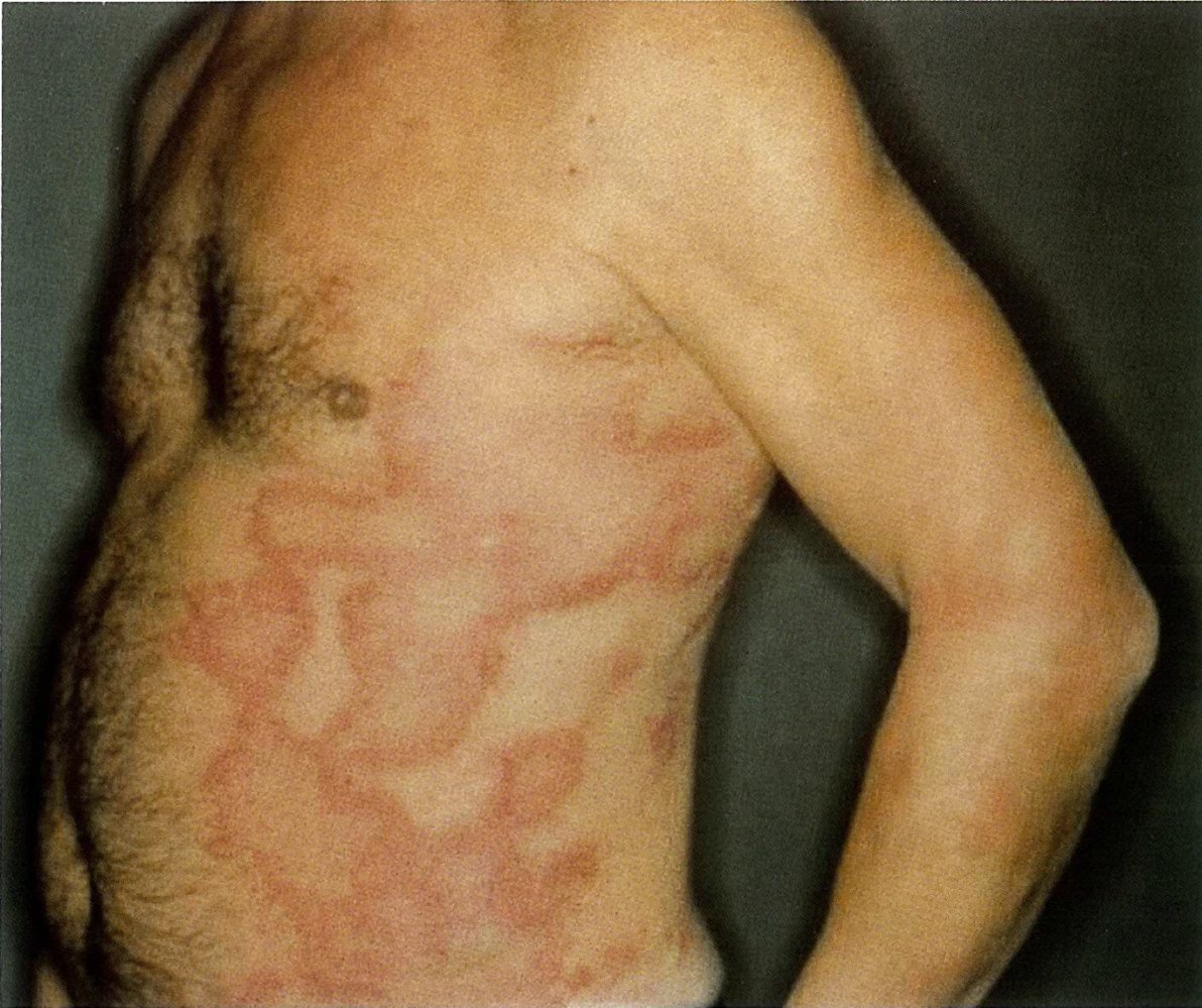 Urticaria