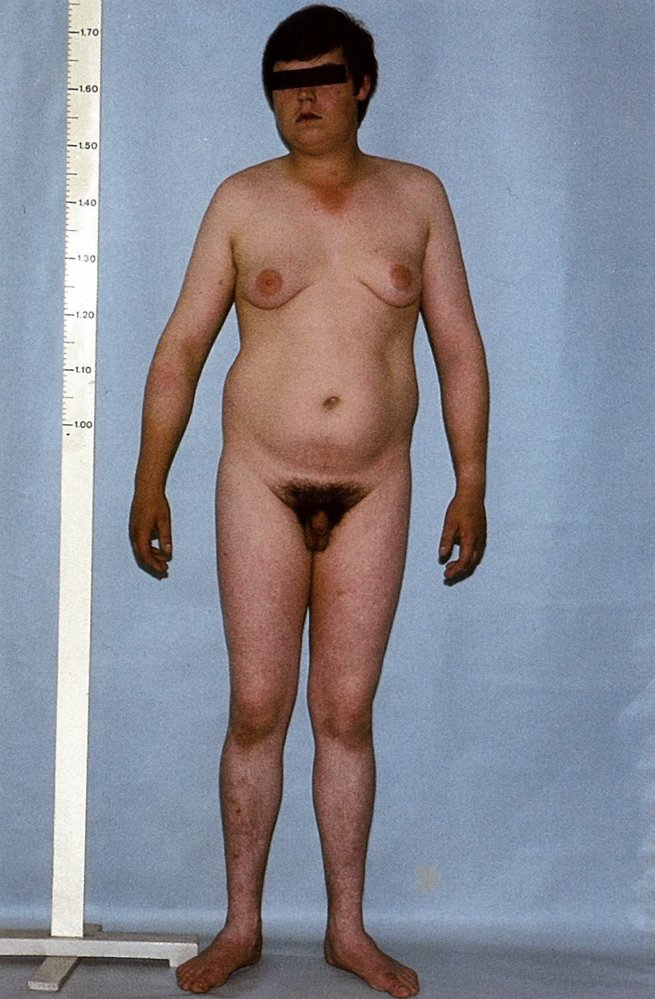Klinefelter syndrome