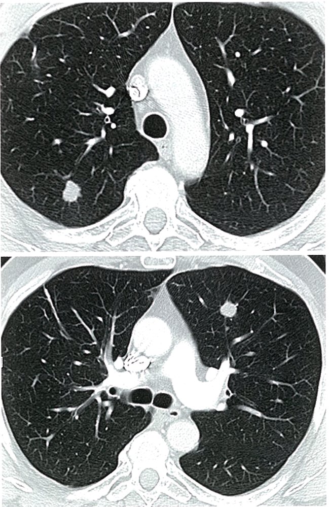 Lung metastases