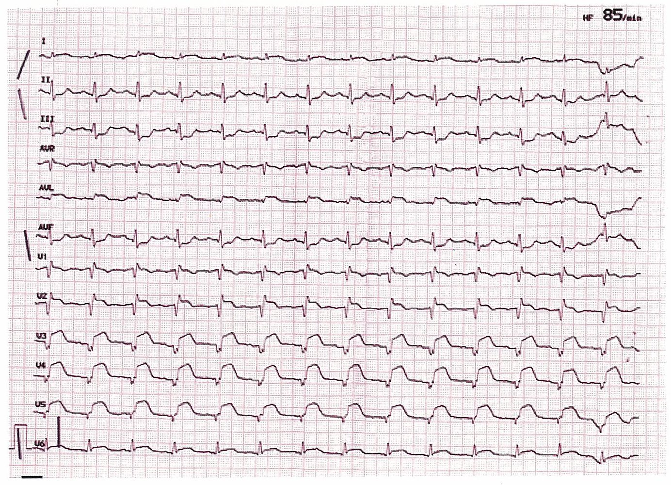 Acute anterior ST-elevation myocardial infarction (STEMI)