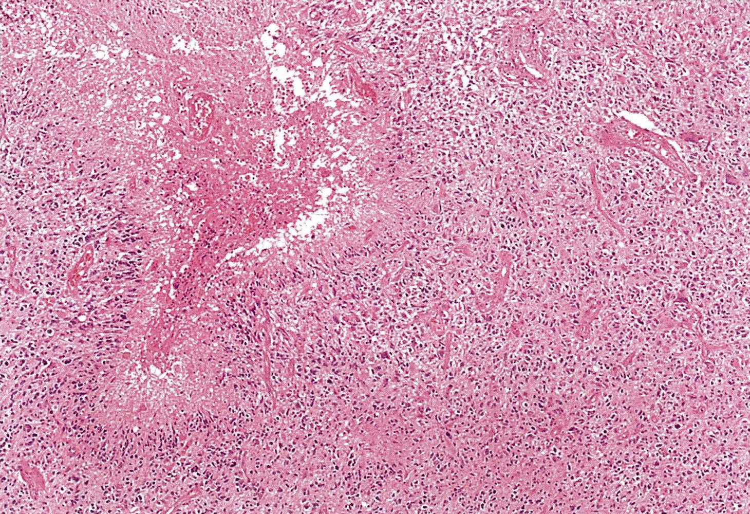 Glioblastoma