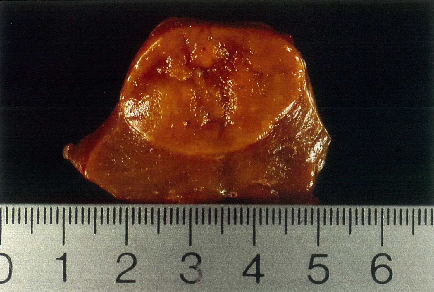 Oncocytoma