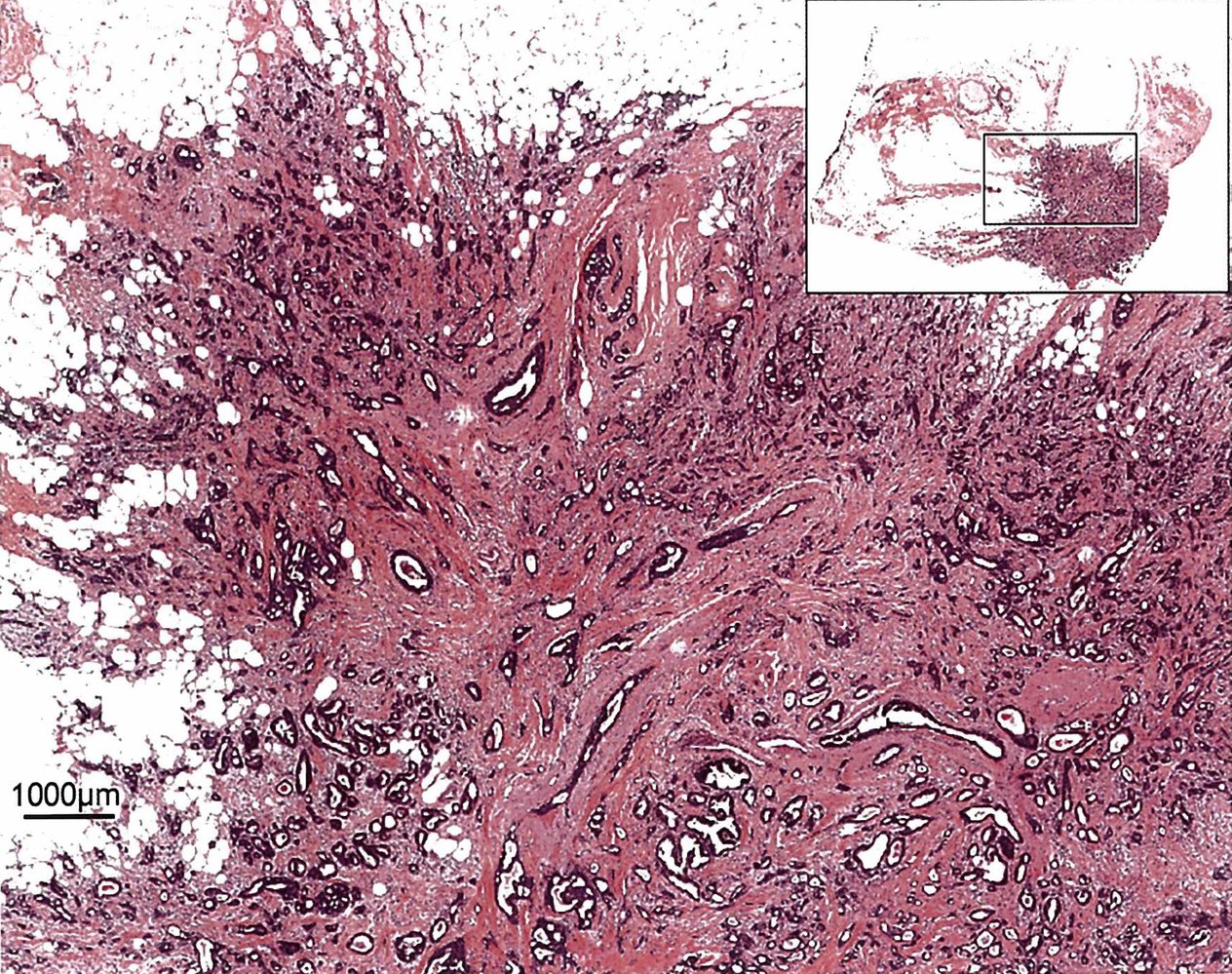 Invasive breast carcinoma of no special type (invasive ductal carcinoma) 1/3