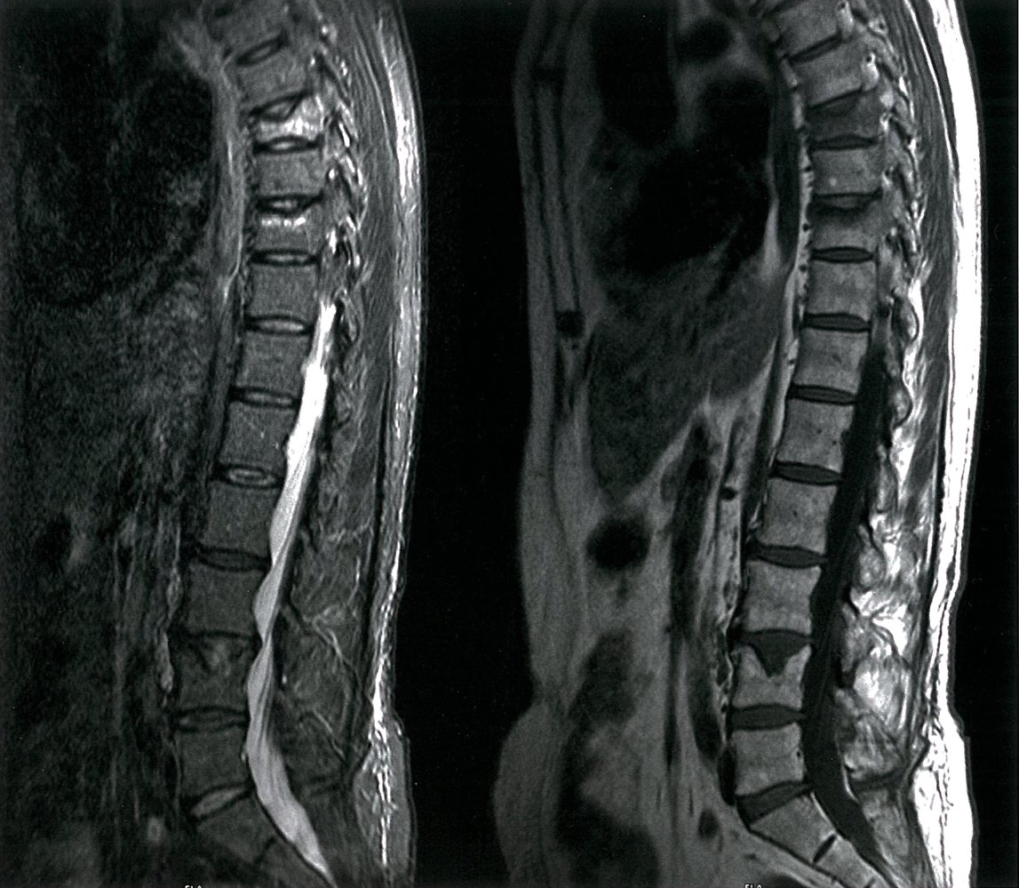 Acute and chronic vertebral fractures