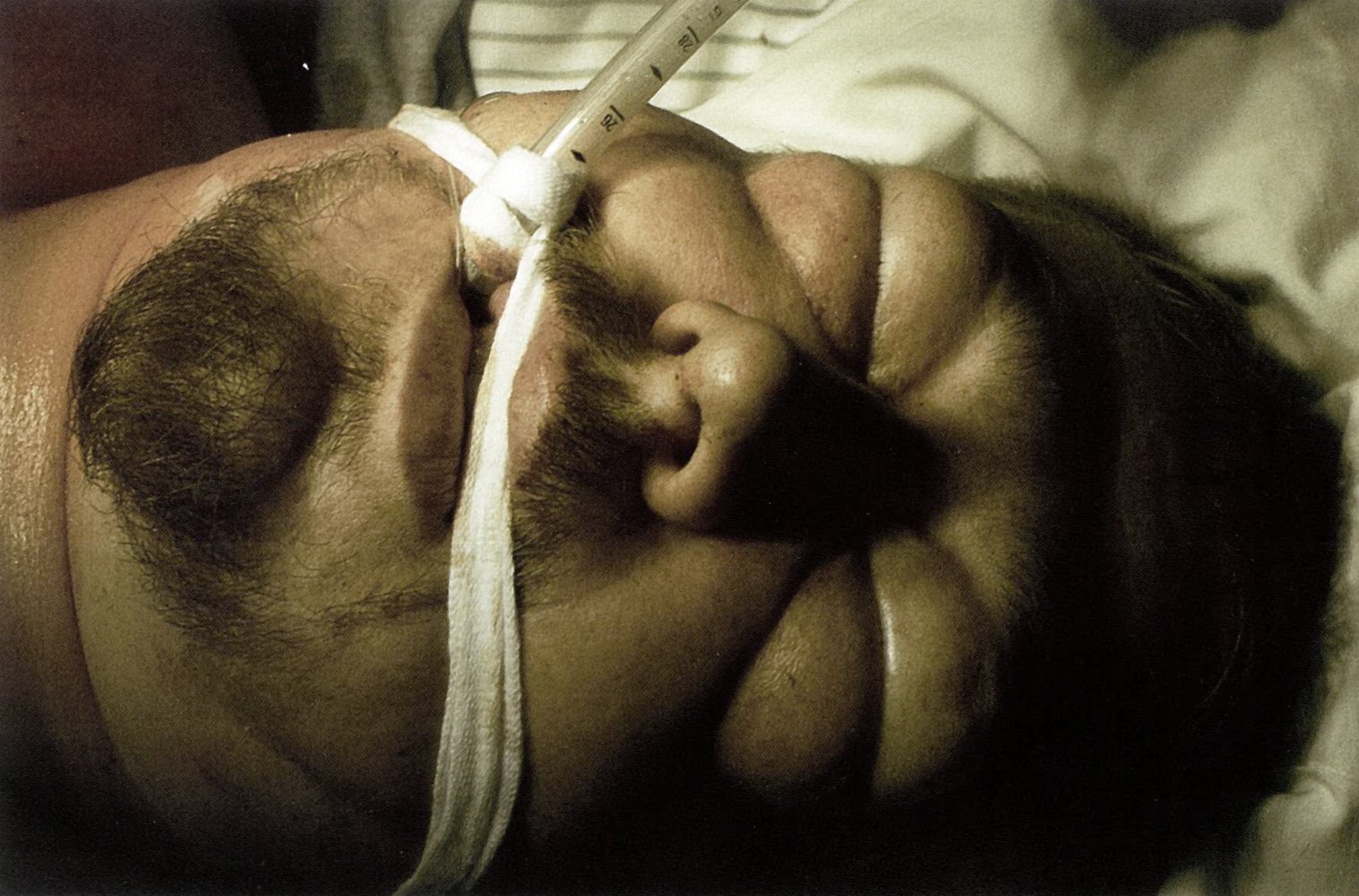 Subcutaneous emphysema after bronchial rupture