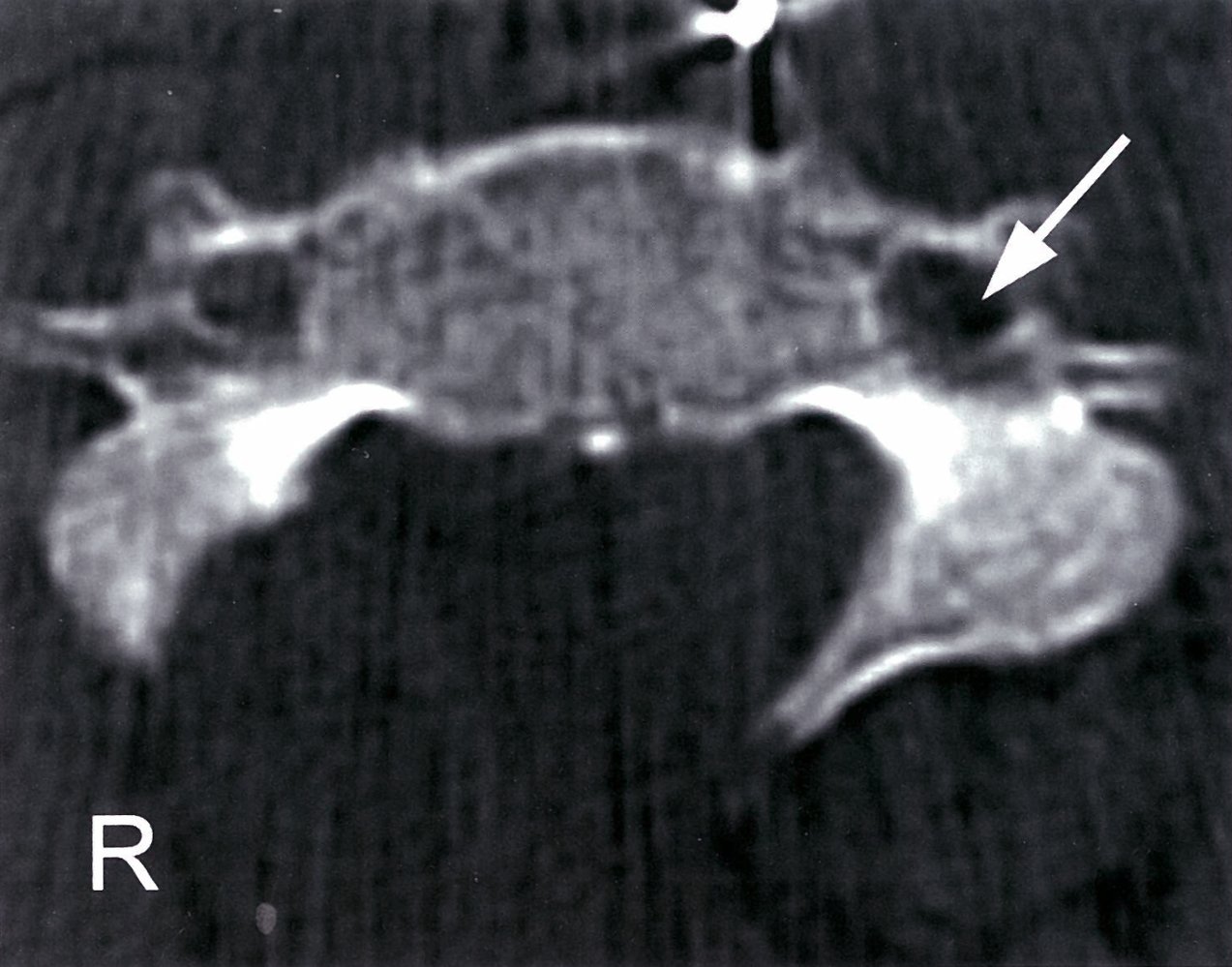 Transverse foramen (Foramen transversarium)