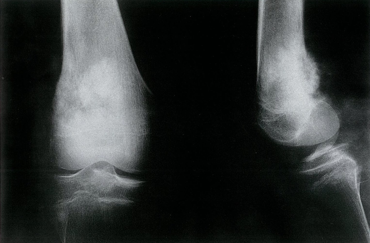 Osteosarcoma of the distal femur
