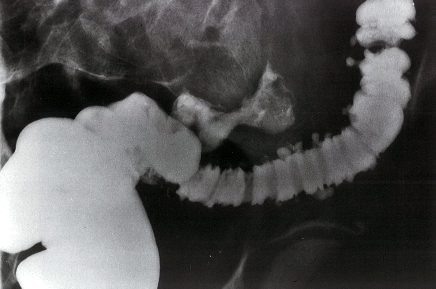 Fistula following a ruptured diverticulum