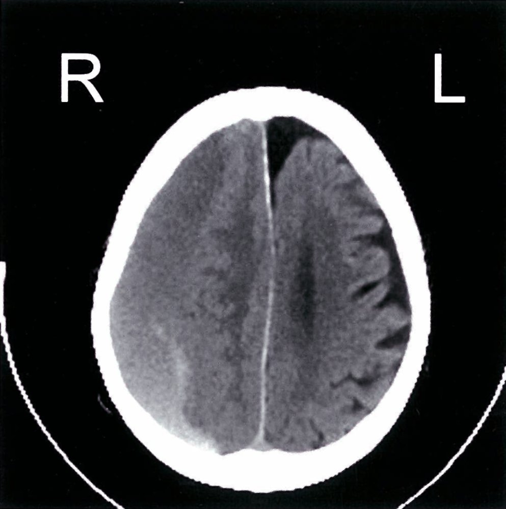 Acute-on-chronic subdural hematoma