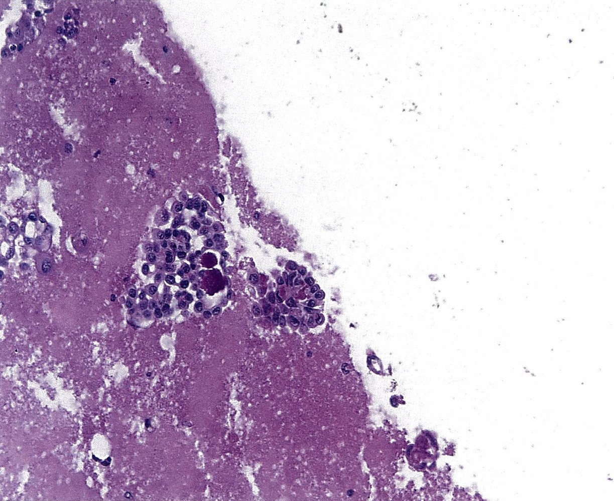Malignant pleural effusion secondary to ovarian cancer