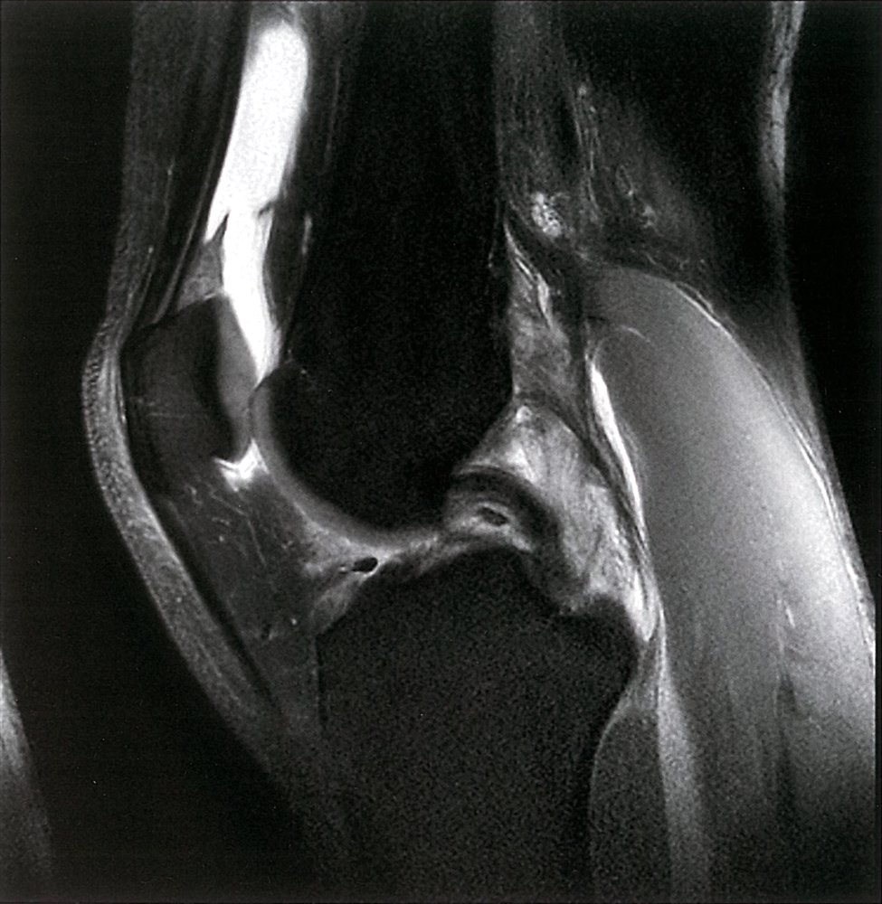 MRI image of suprapatellar joint effusion and intact posterior cruciate ligament of the knee