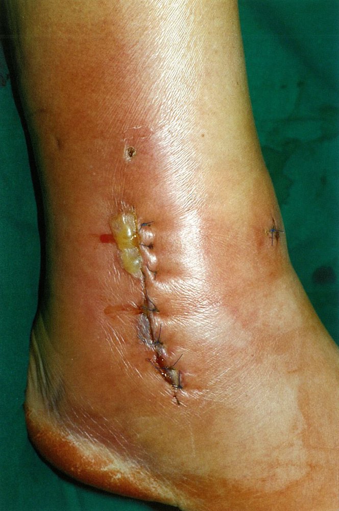 Postoperative infection of the ankle