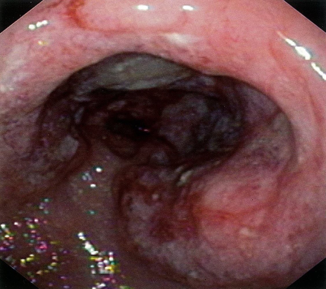 B-cell non-Hodgkin lymphoma of the stomach
