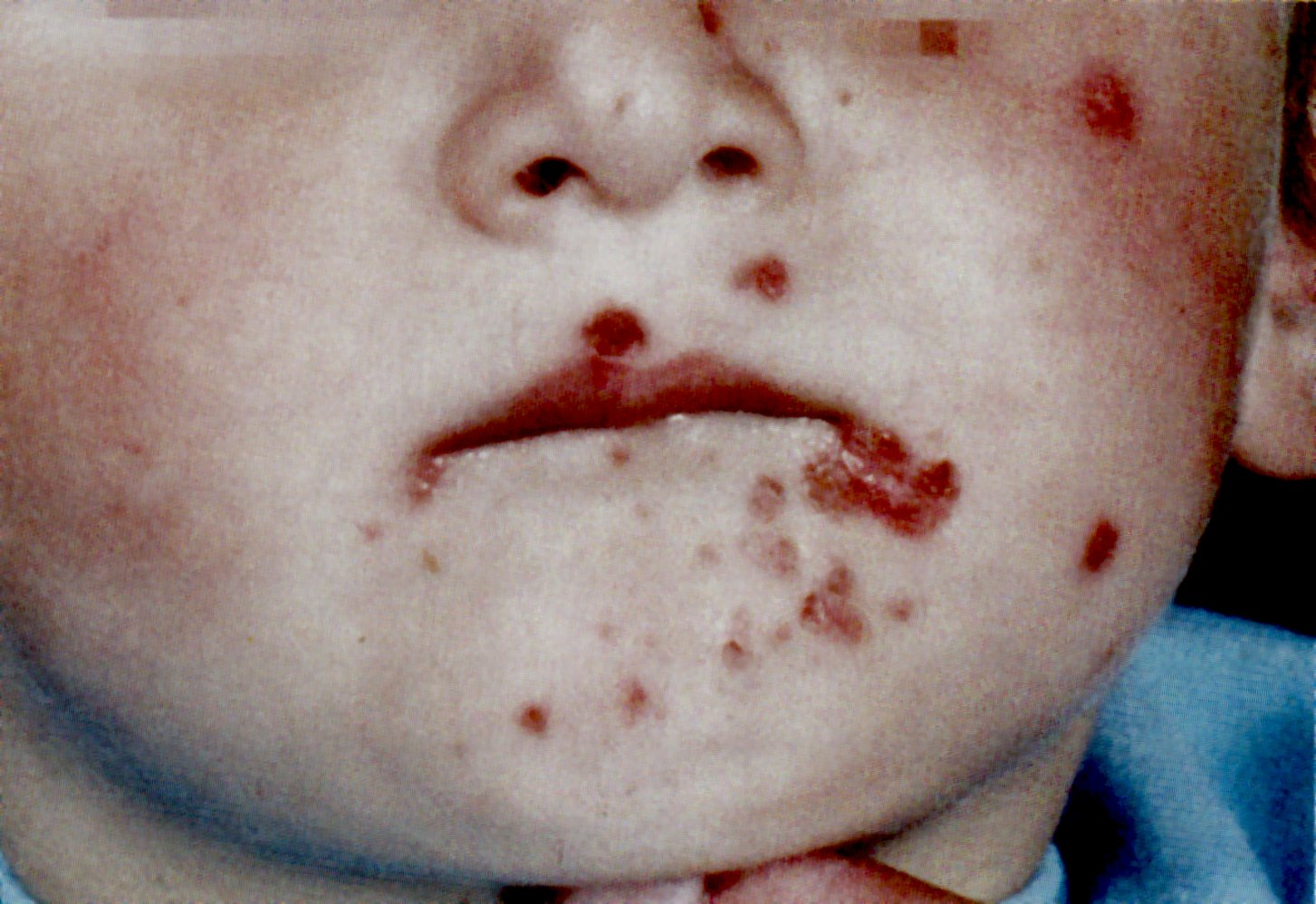 Nonbullous impetigo