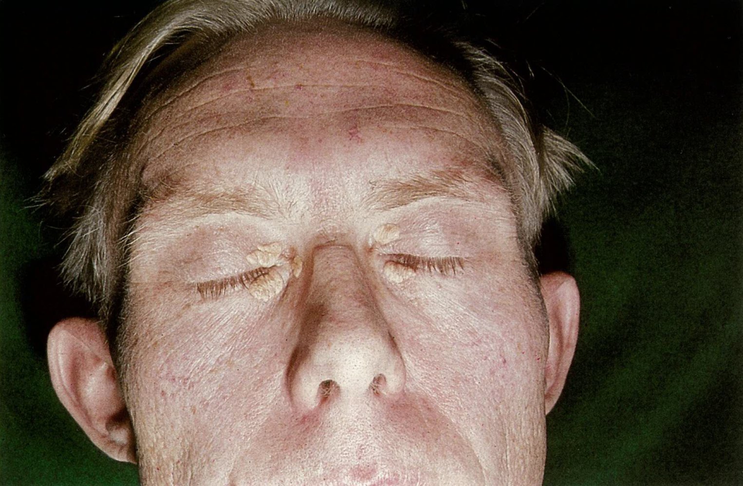 Xanthelasma