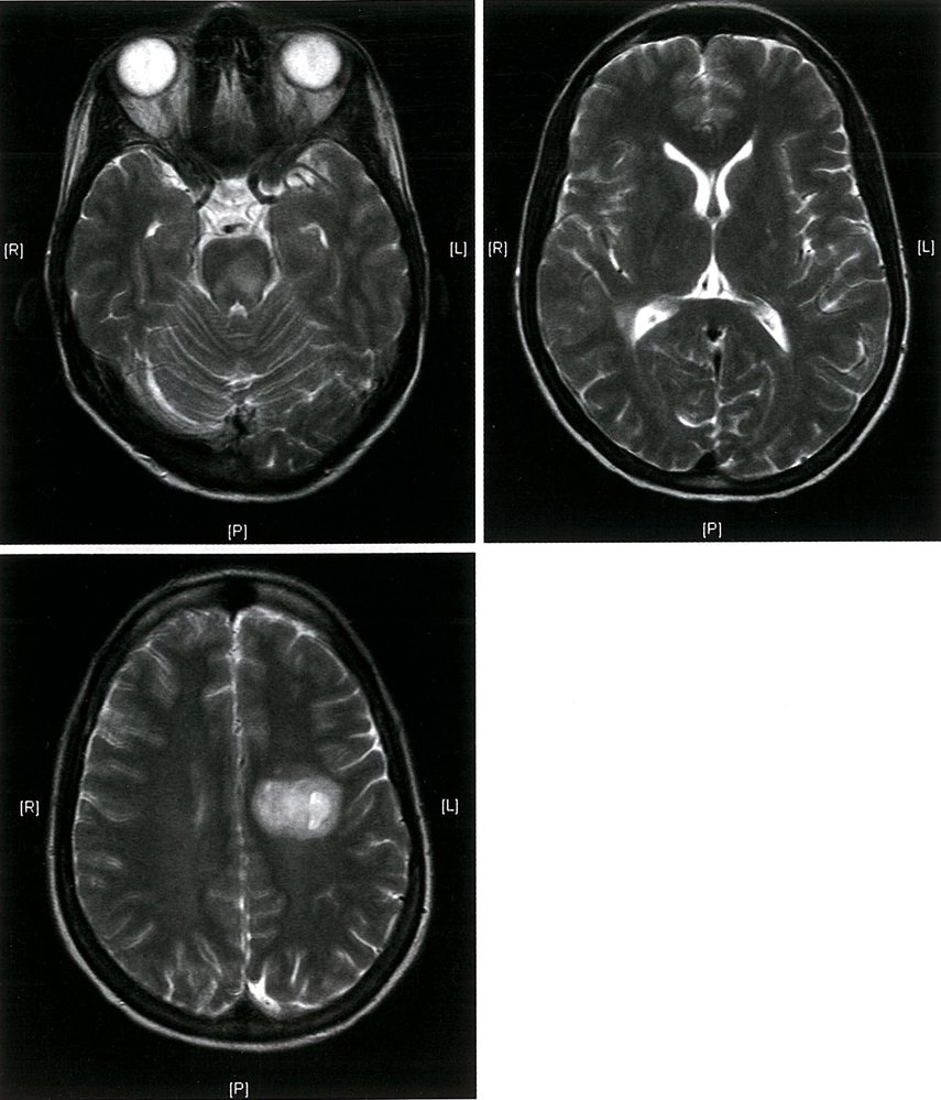 Multiple sclerotic plaques in the subcortical white matter