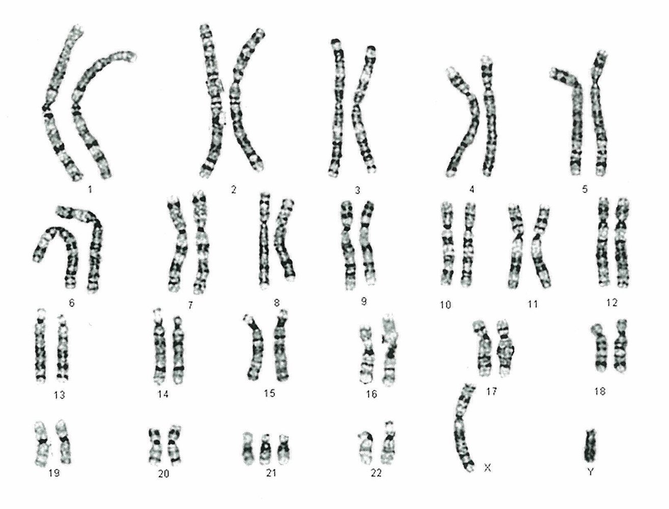 Karyogram in full trisomy 21