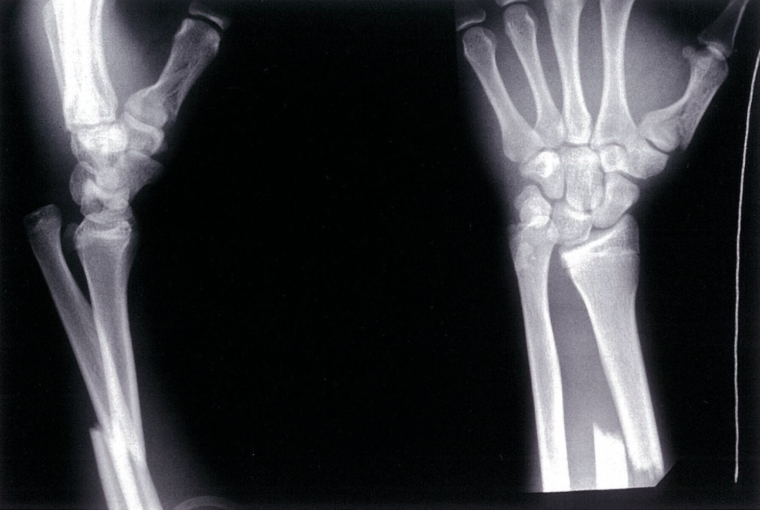 Galeazzi fracture and fracture of the first metacarpal bone