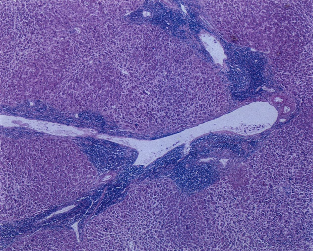 Hepatomegaly in chronic lymphocytic leukemia