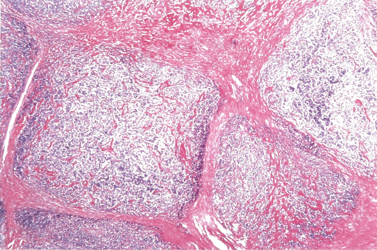 Nodular sclerosing Hodgkin lymphoma