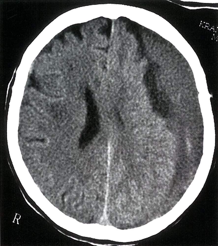 Chronic subdural hematoma