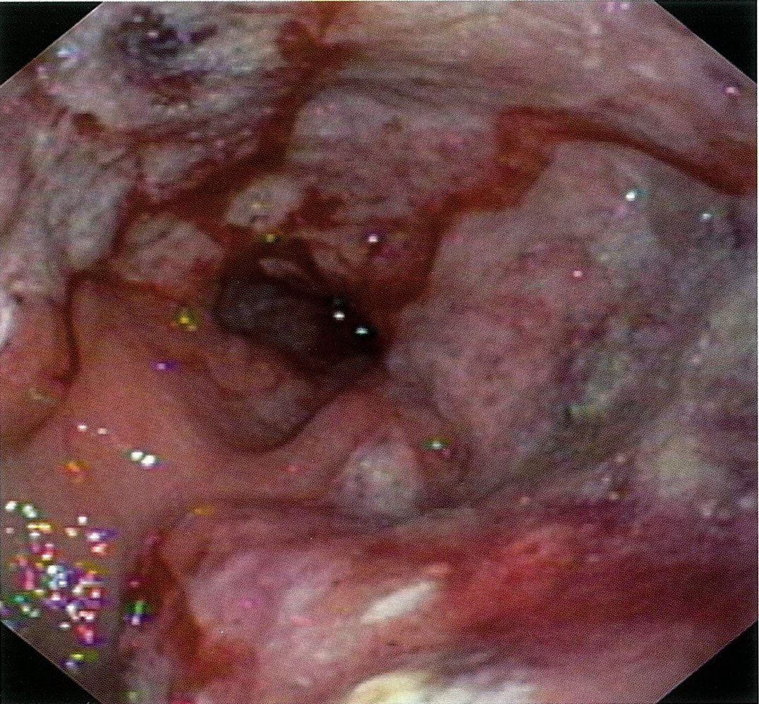 B-cell non-Hodgkin lymphoma of the stomach
