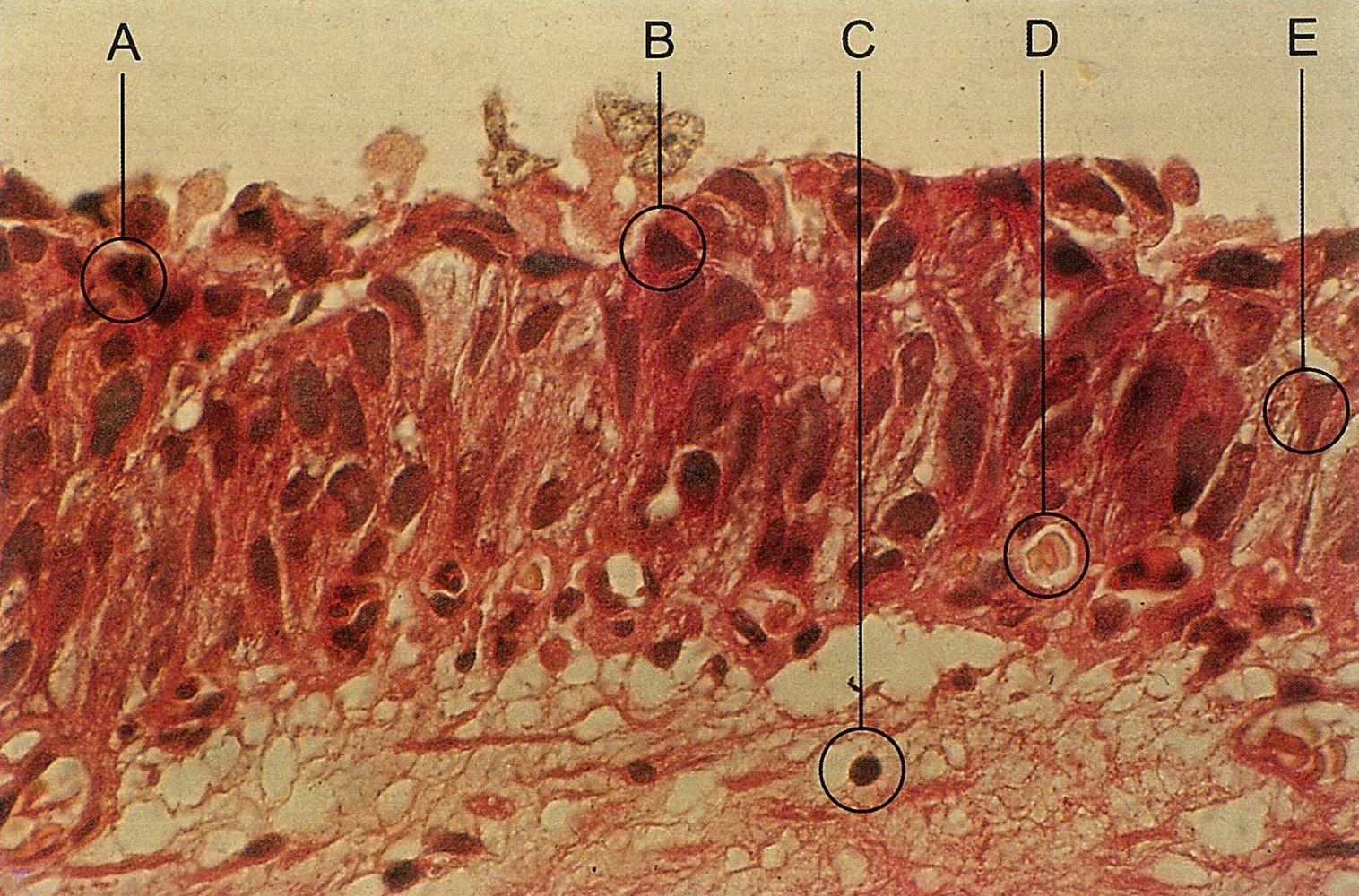 Papillary urothelial carcinoma