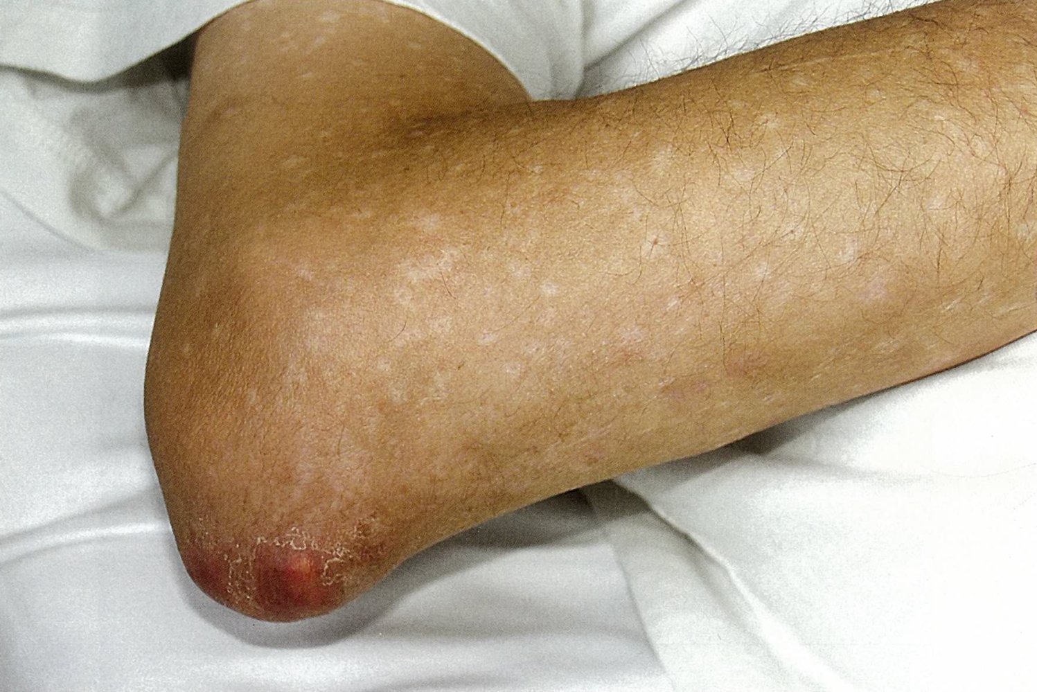 Soft tissue tophi