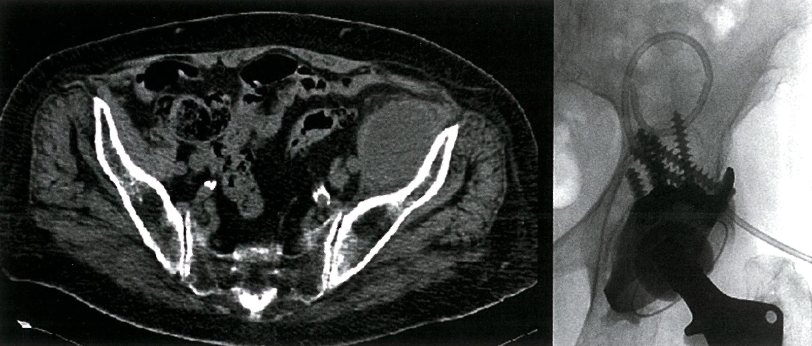 Psoas abscess (fluoroscopy-guided drainage)