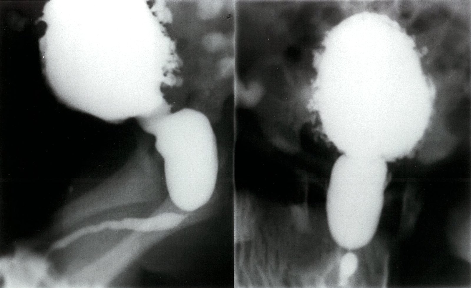 Voiding cystourethrogram in a newborn with proximal congenital urethral stricture