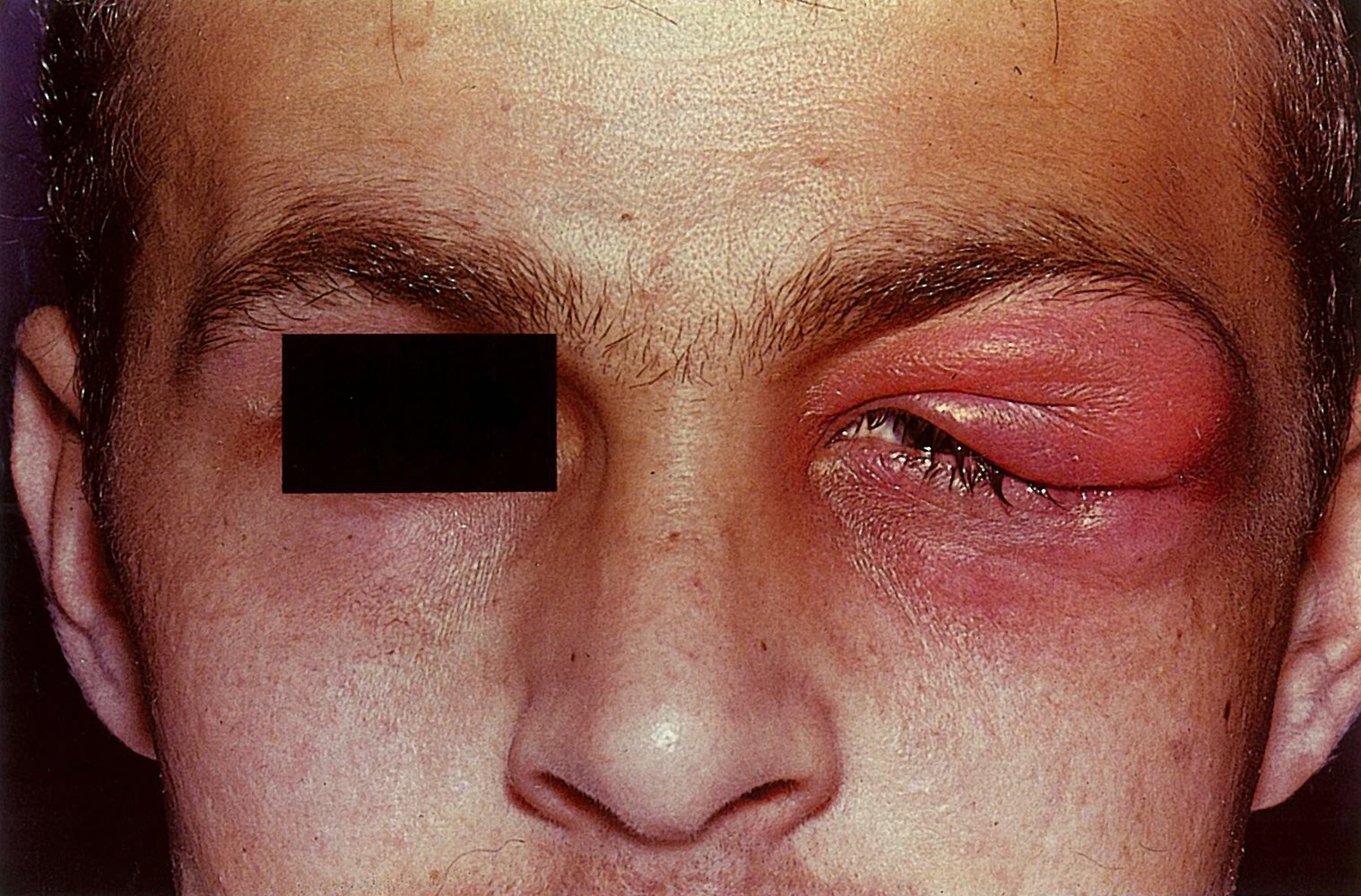 Acute dacryoadenitis