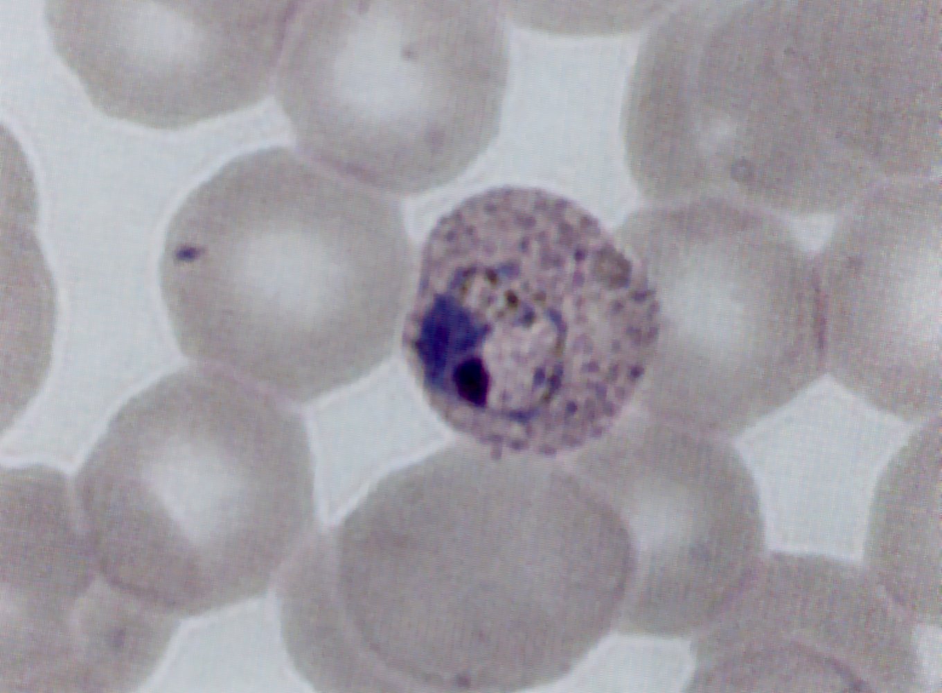 Tertian malaria: immature trophozoite in Plasmodium vivax infection