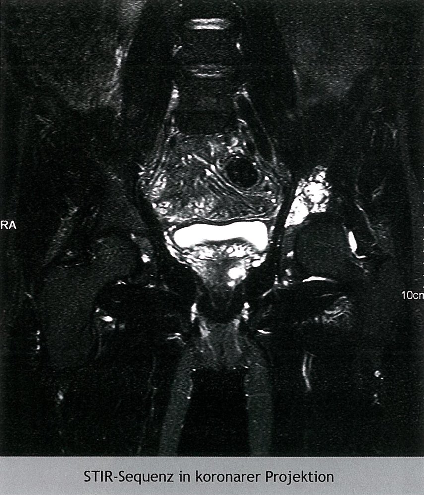 Grade I chondrosarcoma of the left acetabulum