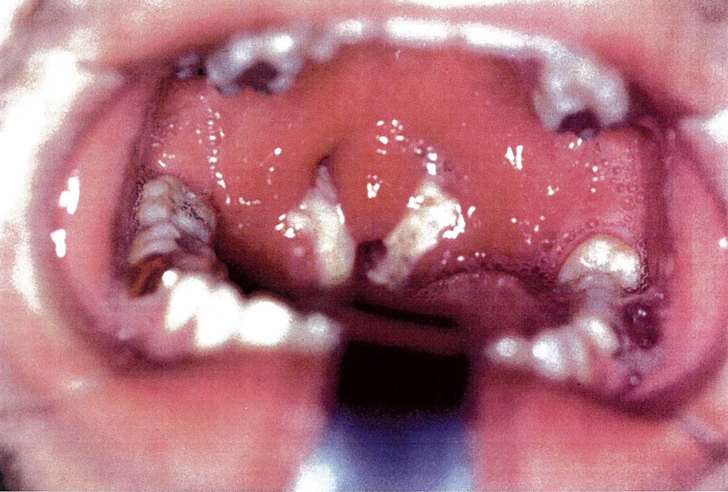 Membranous tonsillitis