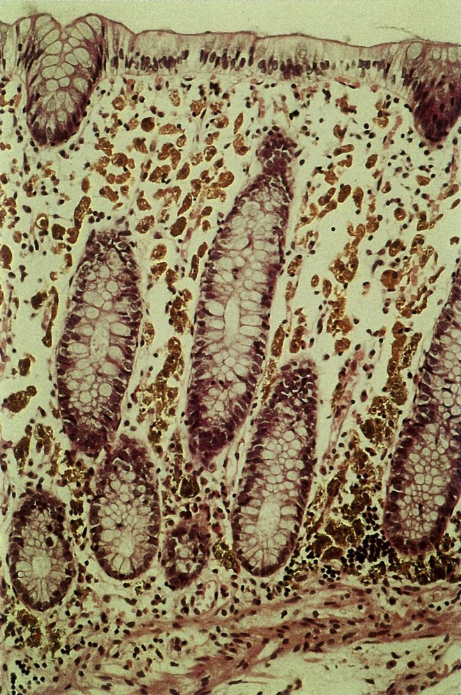 Melanosis coli in chronic laxative abuse