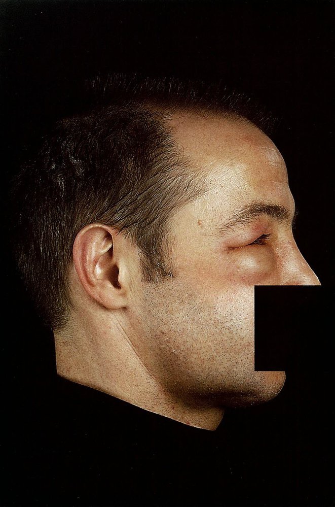 Hereditary angioedema