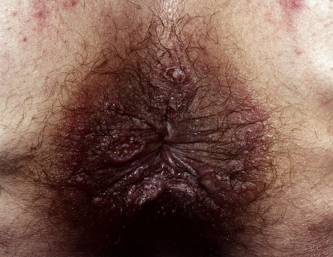 Condylomata lata in secondary syphilis
