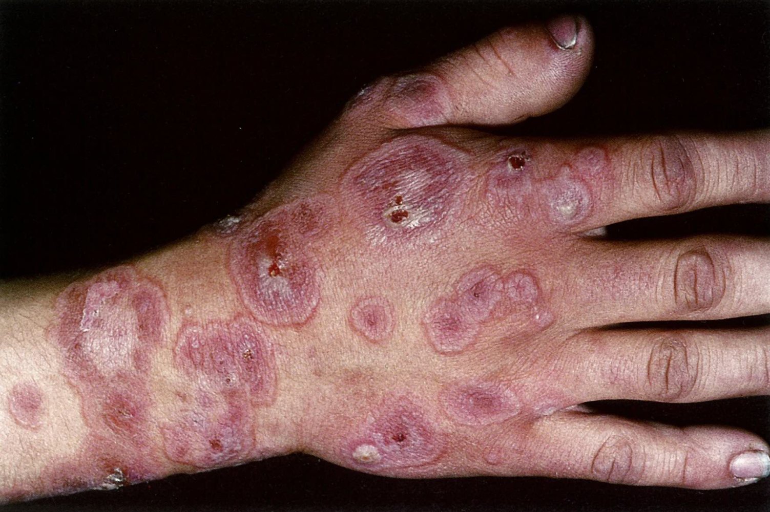 Target lesions in erythema multiforme