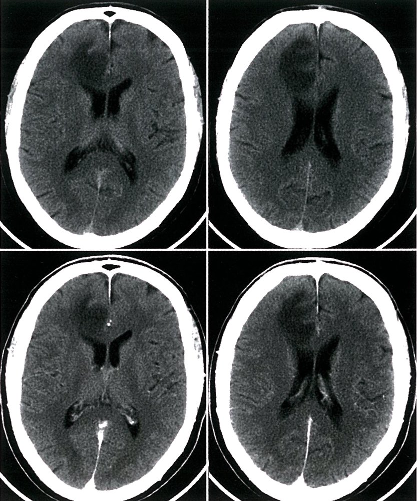 Astrocytoma