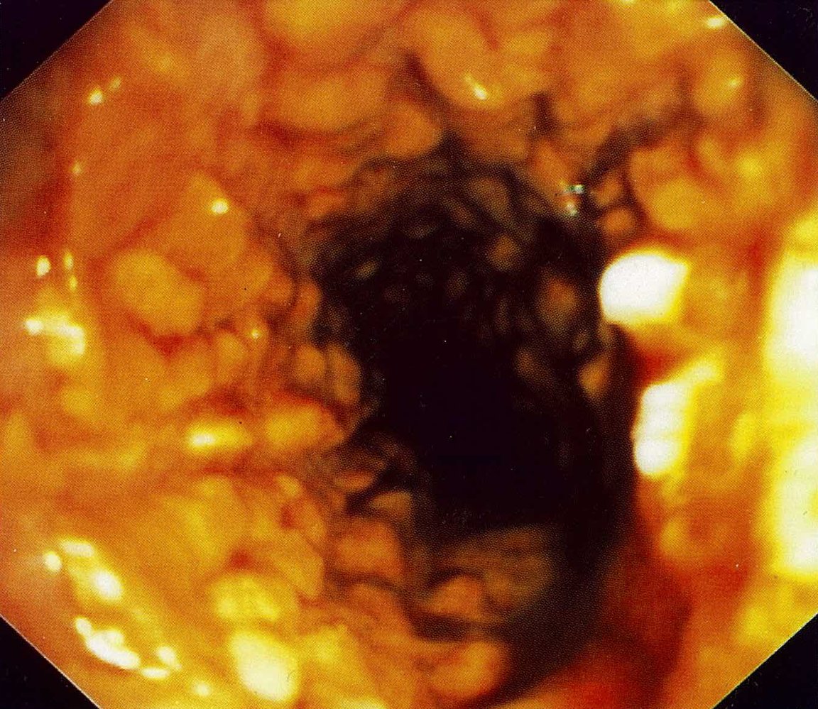 Intestinal tuberculosis