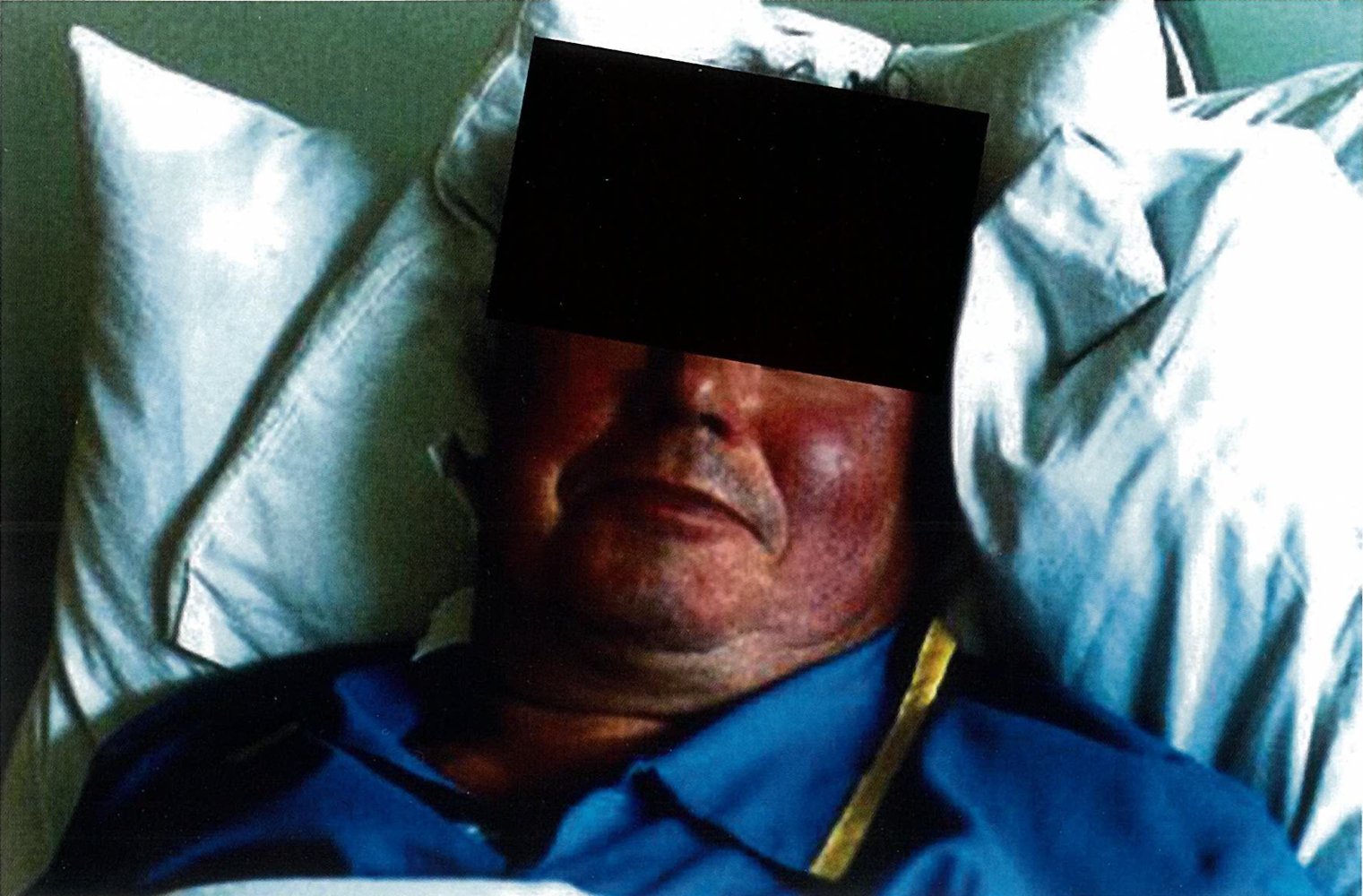 Facial features in chronic bronchitis