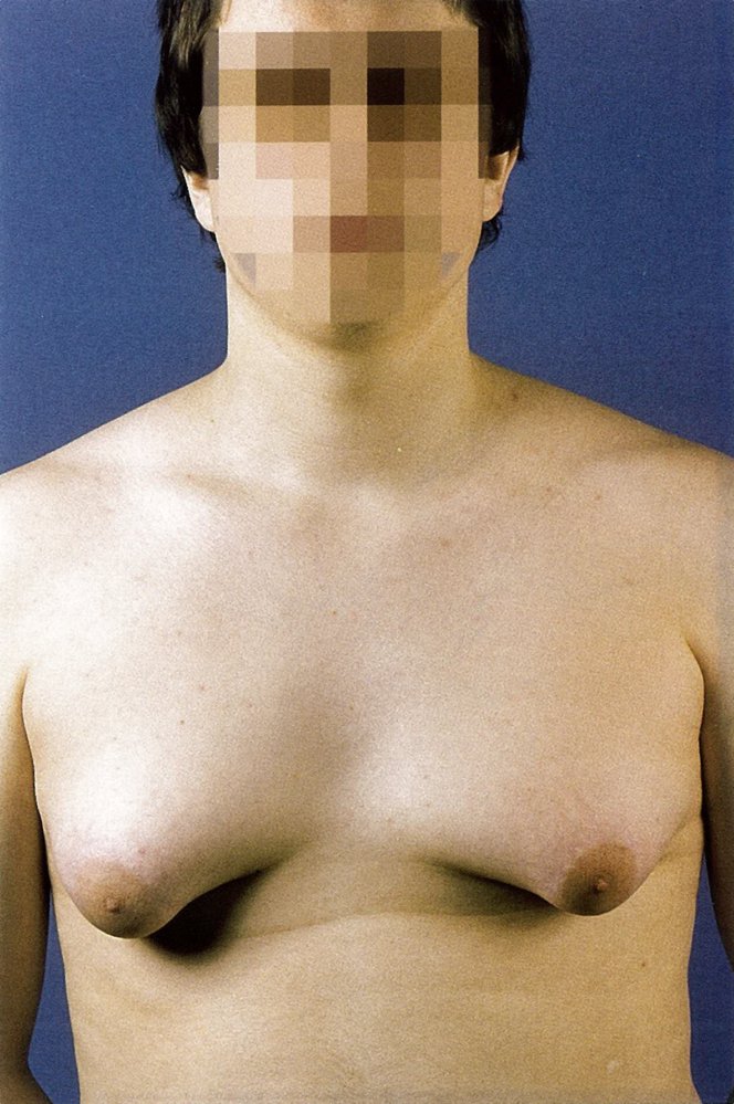 Bilateral gynecomastia in Klinefelter syndrome