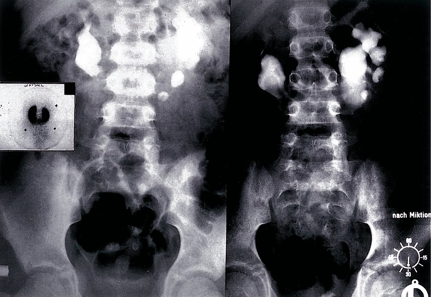 Horseshoe kidney with hydronephrosis