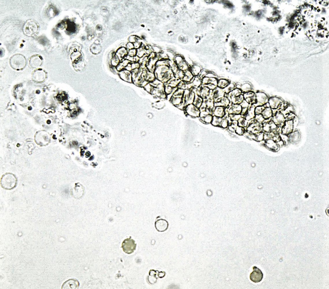 Red blood cell cast