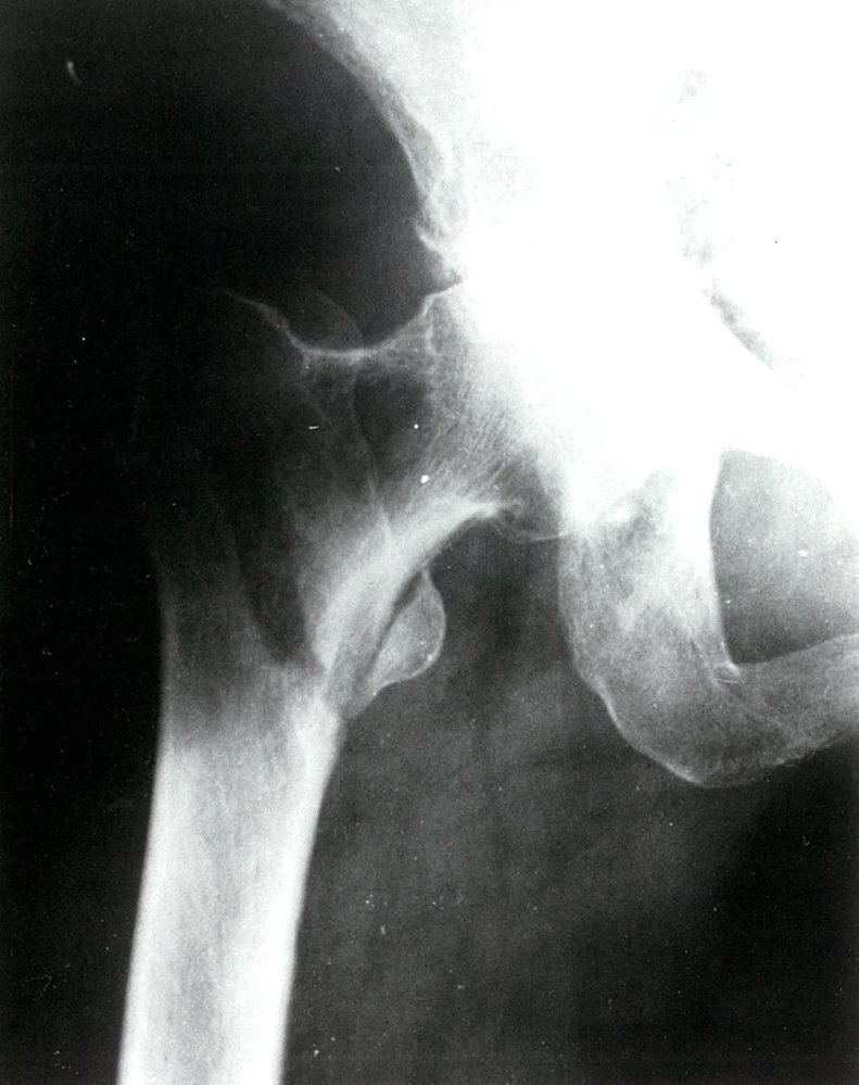 Intertrochanteric femoral fracture