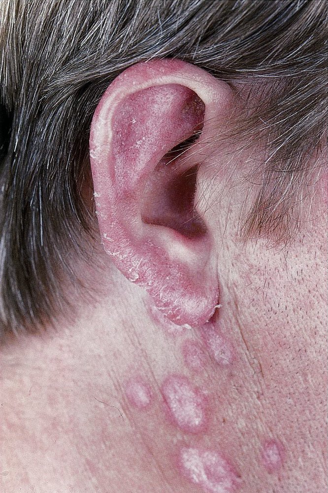 Discoid lupus erythematosus
