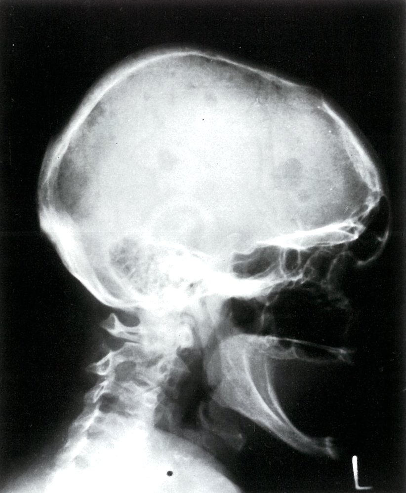 Osteolytic skull lesions