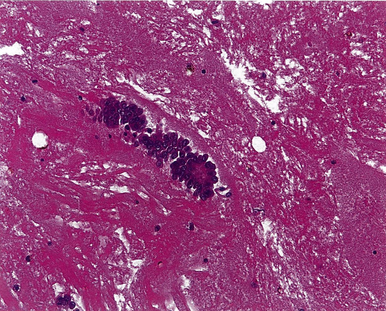 Malignant pleural effusion secondary to ovarian cancer